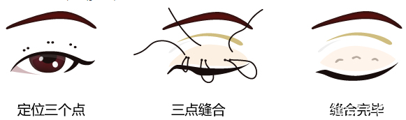 爱思特韩式双眼皮手术过程