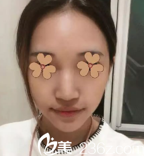 安康蝶姿美容门诊部做双眼皮比隆鼻多 安康蝶姿美容门诊部做双眼皮比隆鼻多