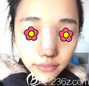 安康蝶姿美容门诊部隆鼻天 安康蝶姿美容门诊部隆鼻天