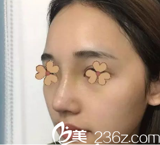 安康蝶姿美容门诊部隆鼻第20天的样子 安康蝶姿美容门诊部隆鼻第20天的样子