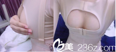 北京美莱整形美容自体脂肪丰胸术后3天效果