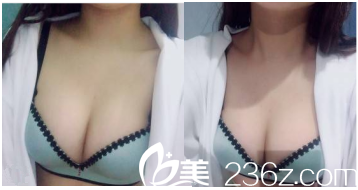 北京美莱自体脂肪隆胸3月效果 北京美莱自体脂肪隆胸3月效果