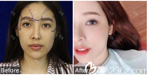 广州韩妃整形医院曾繁茂自体脂肪填充全脸效果图