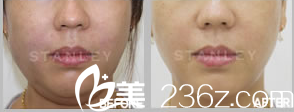 韩国Stanley皮肤科去双下巴效果 韩国Stanley皮肤科去双下巴效果