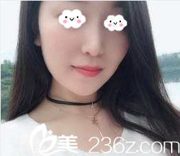 我在北京欧华做鼻综合原因是闺蜜做双眼皮不错你看2月隆鼻效果如何