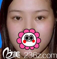 求问济源萍做双眼皮怎么样？分享我手术后效果太自然
