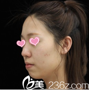 韩国Stanley皮肤科案例注射之前照 韩国Stanley皮肤科案例注射之前照