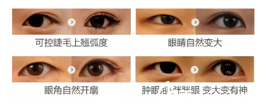 翘睫美瞳术案例 翘睫美瞳术案例