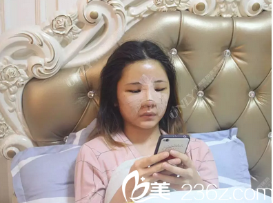 广州壹加壹李明做的隆鼻脂肪填充术后第二天