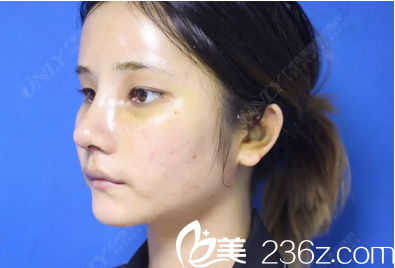 这是找广州壹加壹张红艳做玩两把术后七天恢复照片