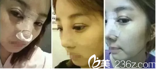 刚做完眼鼻整形术后肿胀