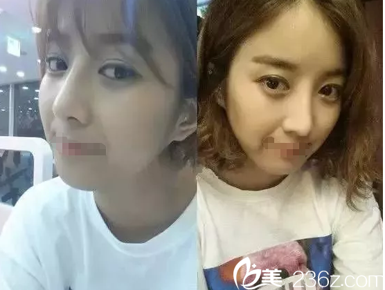 眼鼻整形术后半个月恢复