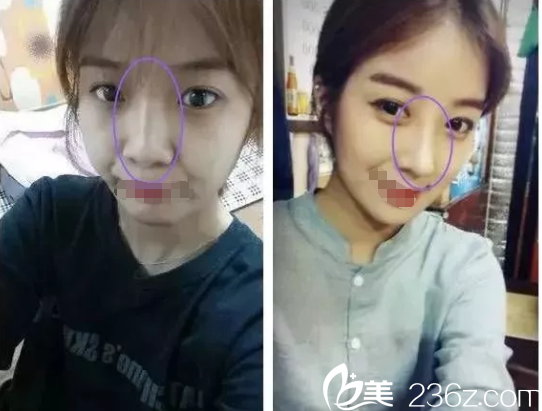 在南京维多利亚做眼鼻整形术后恢复