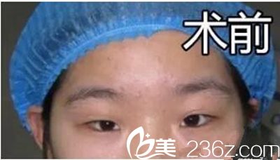 次做双眼皮失败了 次做双眼皮失败了