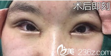 周口缔莱美做双眼皮失败修复 周口缔莱美做双眼皮失败修复