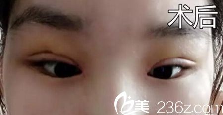 表姐带我去周口缔莱美做双眼皮修复 感谢李士成主任挽救了我的失败双眼皮