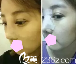 太原华美尹卫民医生给我做双眼皮和鼻综合术后第3天照片