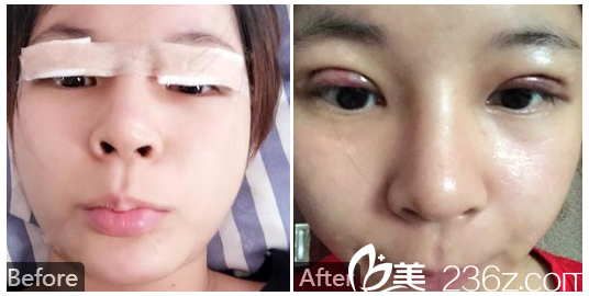 广州苏亚妍雅医学美容医院钟学成做的双眼皮案例对比图