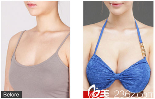 广州苏亚妍雅医疗美容整形医院钟学成自体脂肪隆胸案例对比图