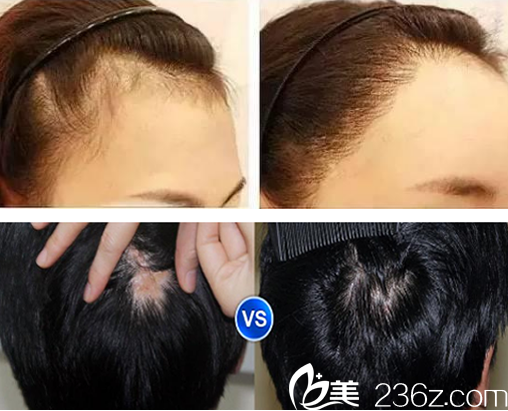 合肥壹美尚方蜜头发种植+疤痕植发案例前后对比图