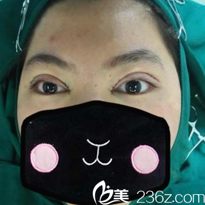 <!--<i data=20240703-sp></i>-->切开双眼皮+祛皮祛脂+开内眼角术