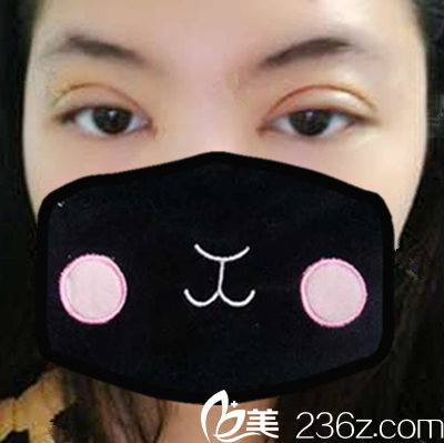 合肥壹美尚切开双眼皮+开内眼角+祛皮祛脂术后第3天照片