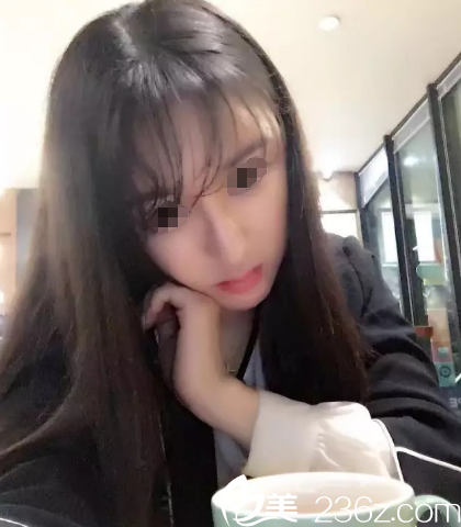 在苏州美贝尔做线雕术后恢复