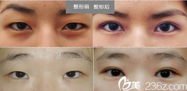 <!--<i data=20240703-sp></li>
<li><i data=20240703-sp></i>-->医生双眼皮案例图