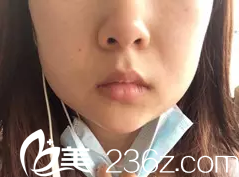 我在太原华美整形美容医院打瘦脸前的照片 我在太原华美整形美容医院打瘦脸前的照片