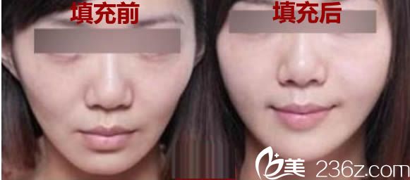 <!--<i data=20240703-sp></li>
<li><i data=20240703-sp></i>-->医生全面部自体脂肪填充前后对比效果