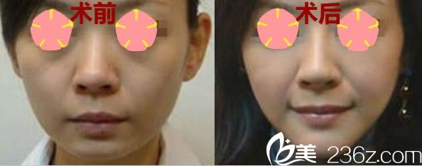 全面部提升案例及前后对比效果 全面部提升案例及前后对比效果