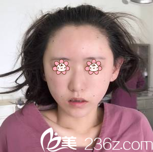 面部填充术后即刻