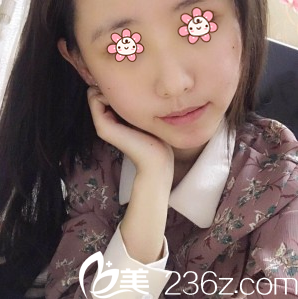 朱红振自体脂肪面部填充术后一周