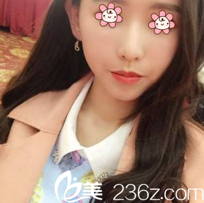 重庆联合丽格面部填充术后11天