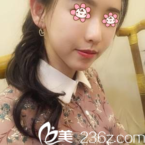 重庆联合丽格朱红振面部脂肪填充术后19天