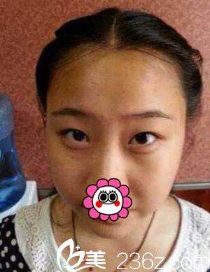 许昌丽娜整形做双眼皮术前 许昌丽娜整形做双眼皮术前