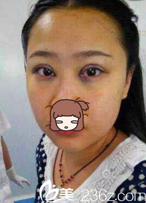 许昌丽娜整形做双眼皮 许昌丽娜整形做双眼皮