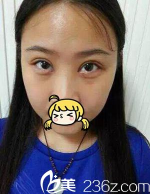 许昌丽娜整形韩式微创双眼皮手术真人体验 术后让我变身清新大眼萌妹子