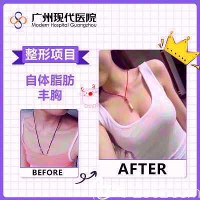 广州现代医学美容医院李月庆自体脂肪隆胸案例对比图