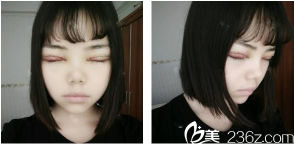 找茂名华美整形医院<!--<i data=20240703-sp></i>-->生医生做完双眼皮天