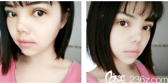 茂名华美<!--<i data=20240703-sp></i>-->生双眼皮案例术后第三天图片