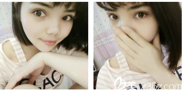 茂名华美双眼皮案例术后七天拆线图