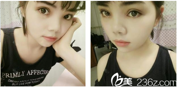 茂名华美整形医院双眼皮案例术后半个月自拍