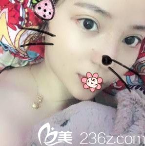 戴霞鼻综合术后8天 戴霞鼻综合术后8天