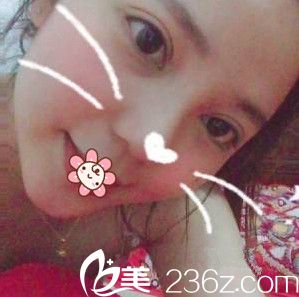 重庆好美整形眼综合术后13天 重庆好美整形眼综合术后13天