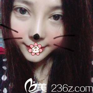 重庆好美整形鼻综合术后19天 重庆好美整形鼻综合术后19天