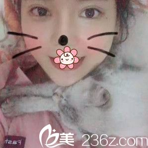 重庆好美整形戴霞眼综合24天 重庆好美整形戴霞眼综合24天