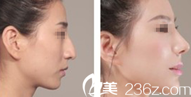 太原欧美莲马世理隆鼻效果对比图