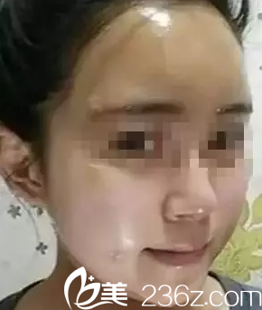 太原华美自体脂肪垫下巴丰太阳穴丰面颊术后第7天效果