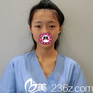 割双眼皮术前照 割双眼皮术前照